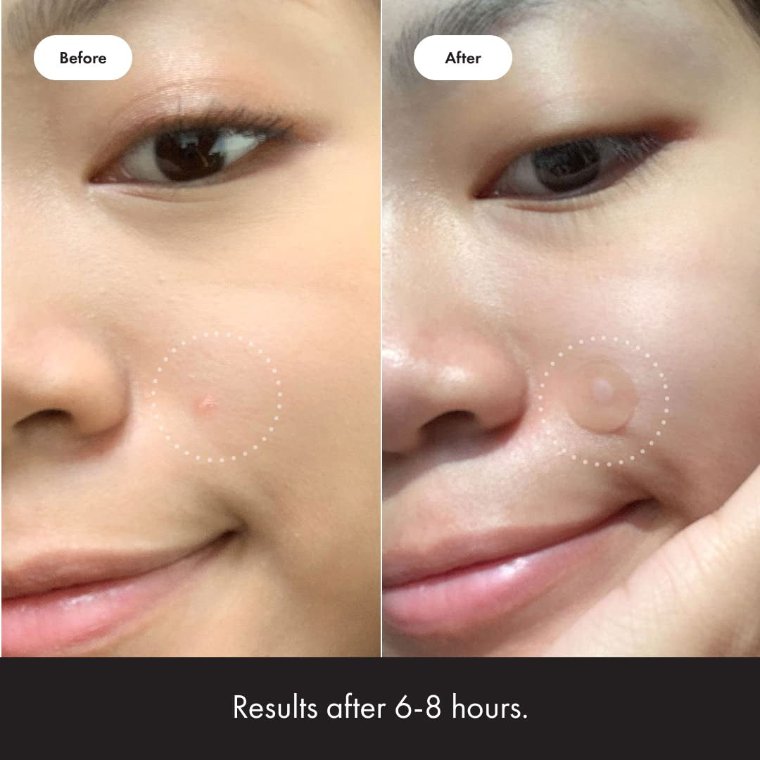Hydrocolloid Acne Pimple Patch