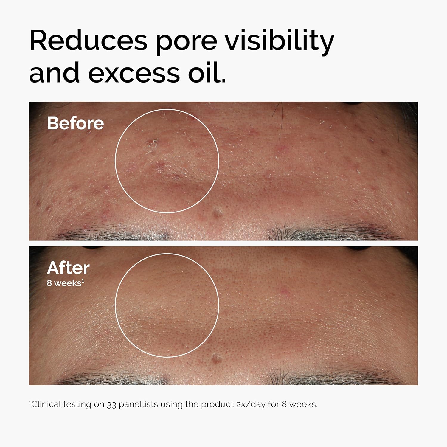  Niacinamide 10% + Zinc 1%, Smoothing Serum for Blemish-Prone Skin
